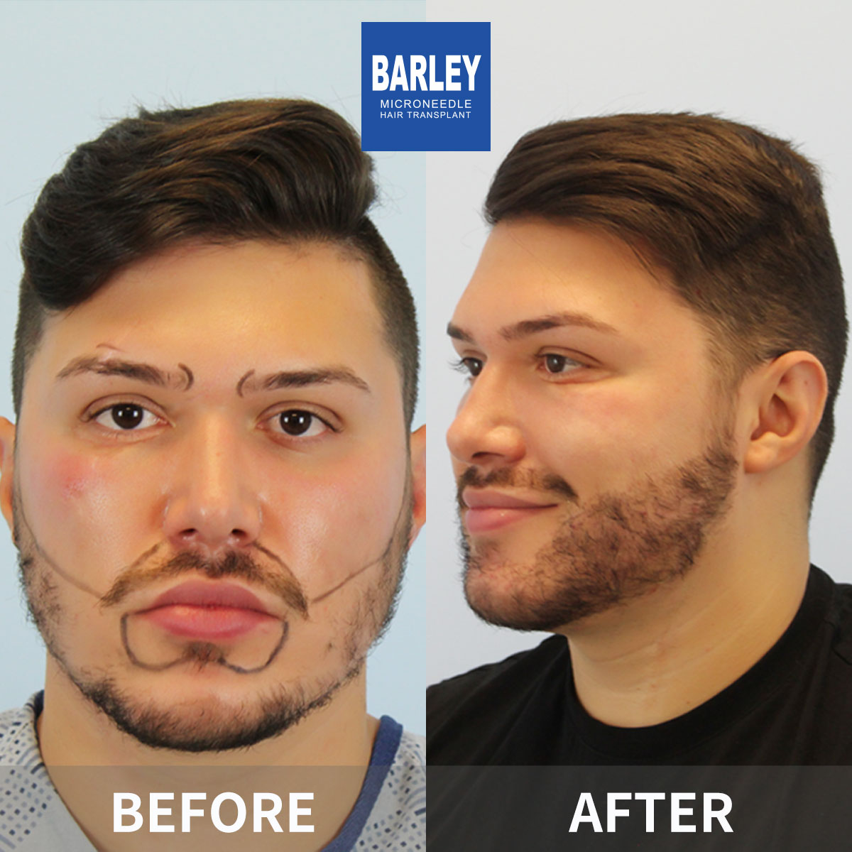 Beard Transplant
