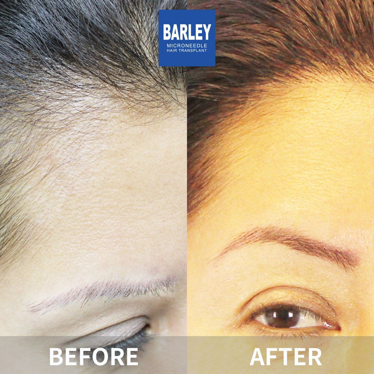 Eyebrow Transplant