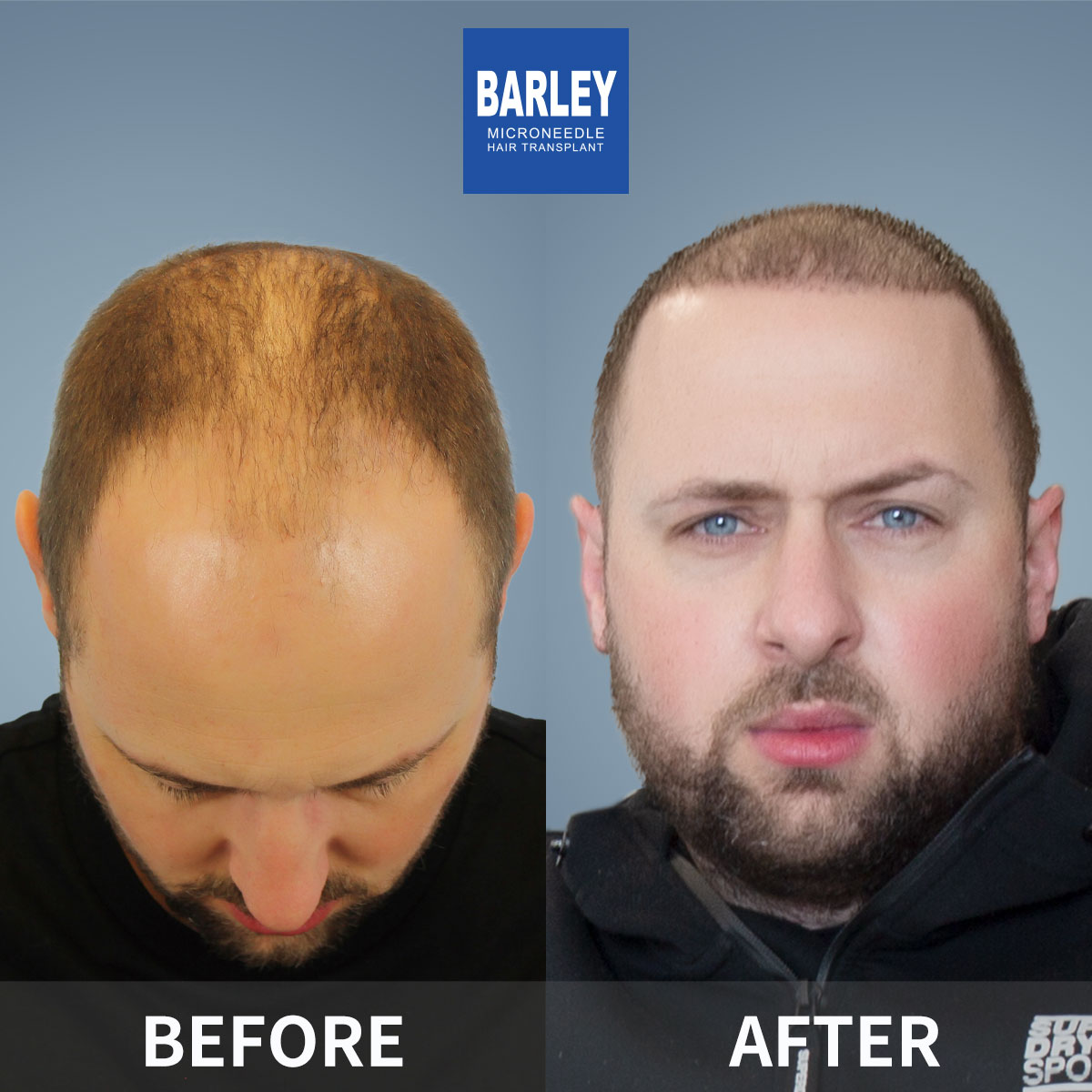 Baldness Restoration